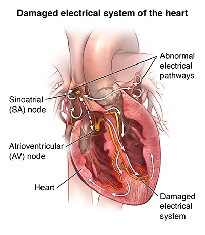 Heart Diagram Explaining Ventricular Arrythmias - 2