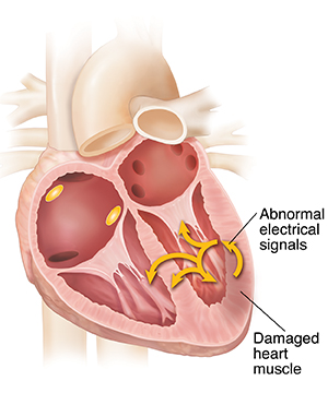 Heart Diagram Explaining Ventricular Arrythmias
