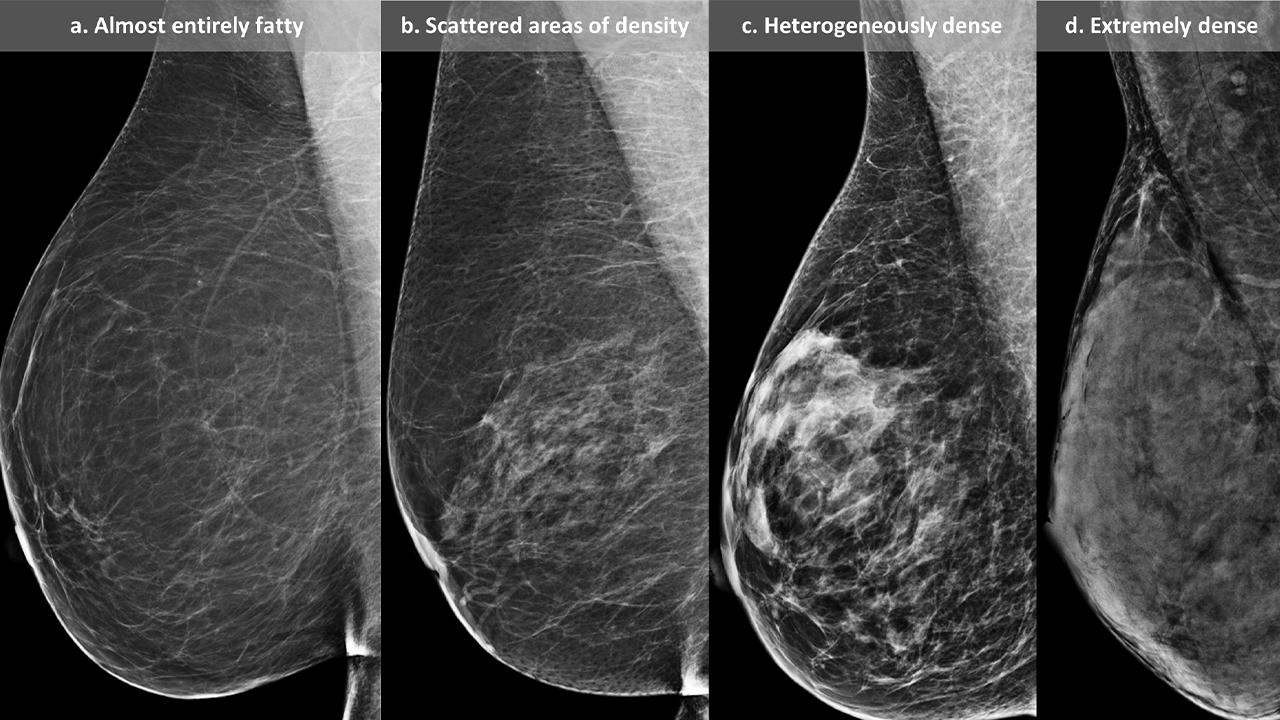 Dense Breast Tissue Breast Cancer Risk and Screening