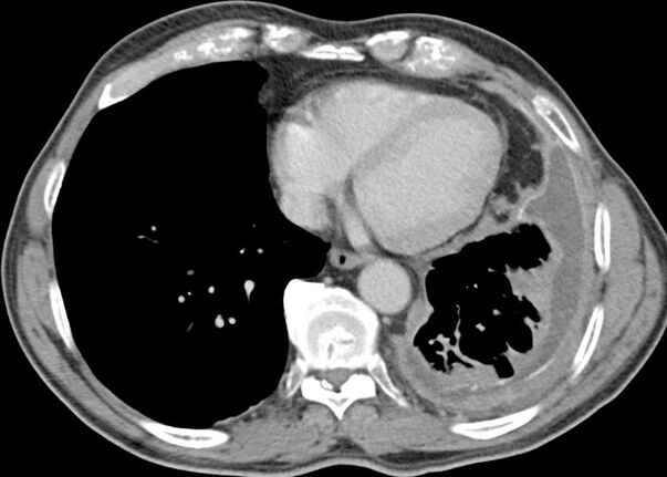 cross section scan of lungs - pleural mesothelioma