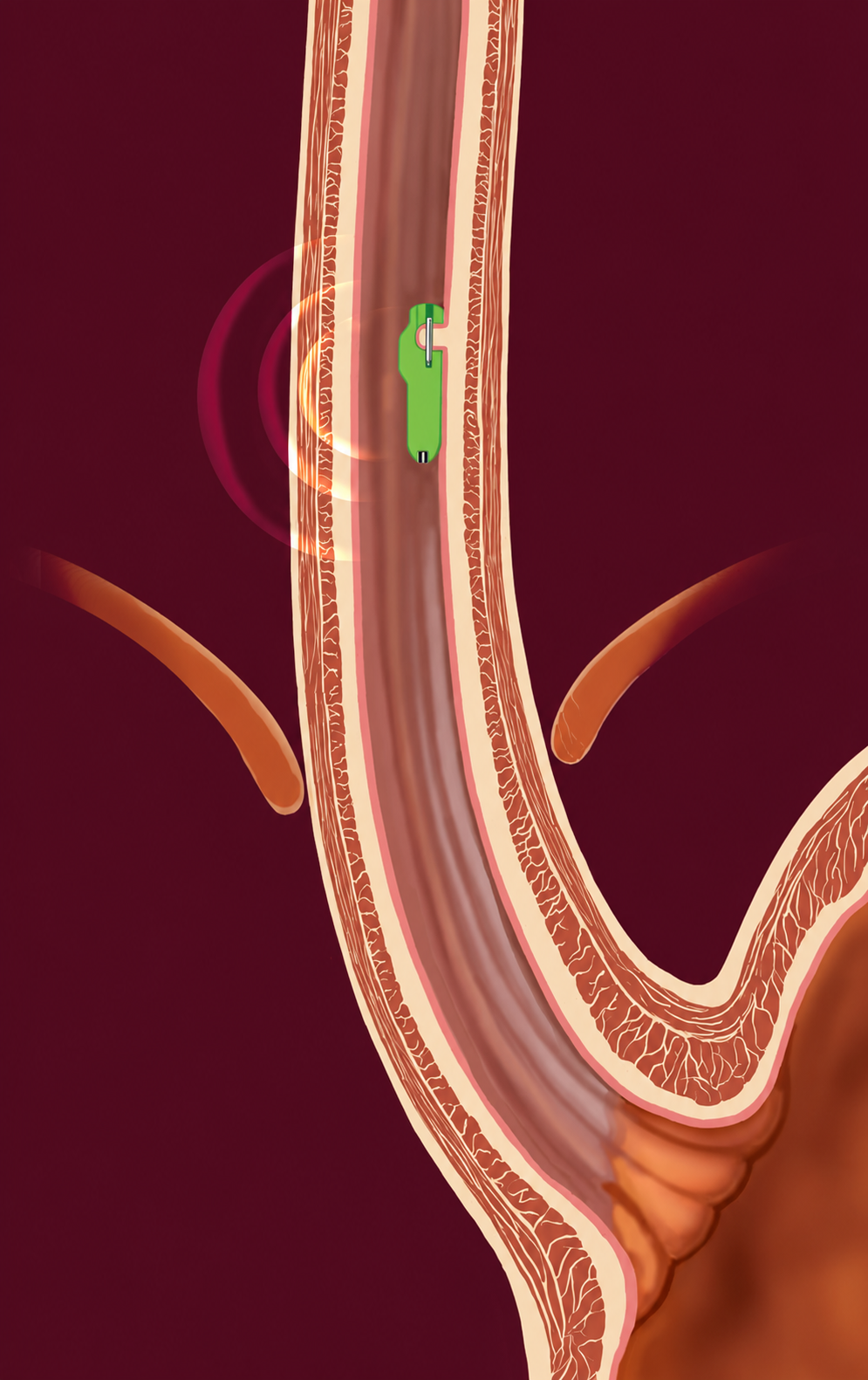 The test involves a miniature pH capsule, which is approximately the size of a gel cap. The capsule is temporarily attached to the wall of your esophagus, as shown in the graphic.