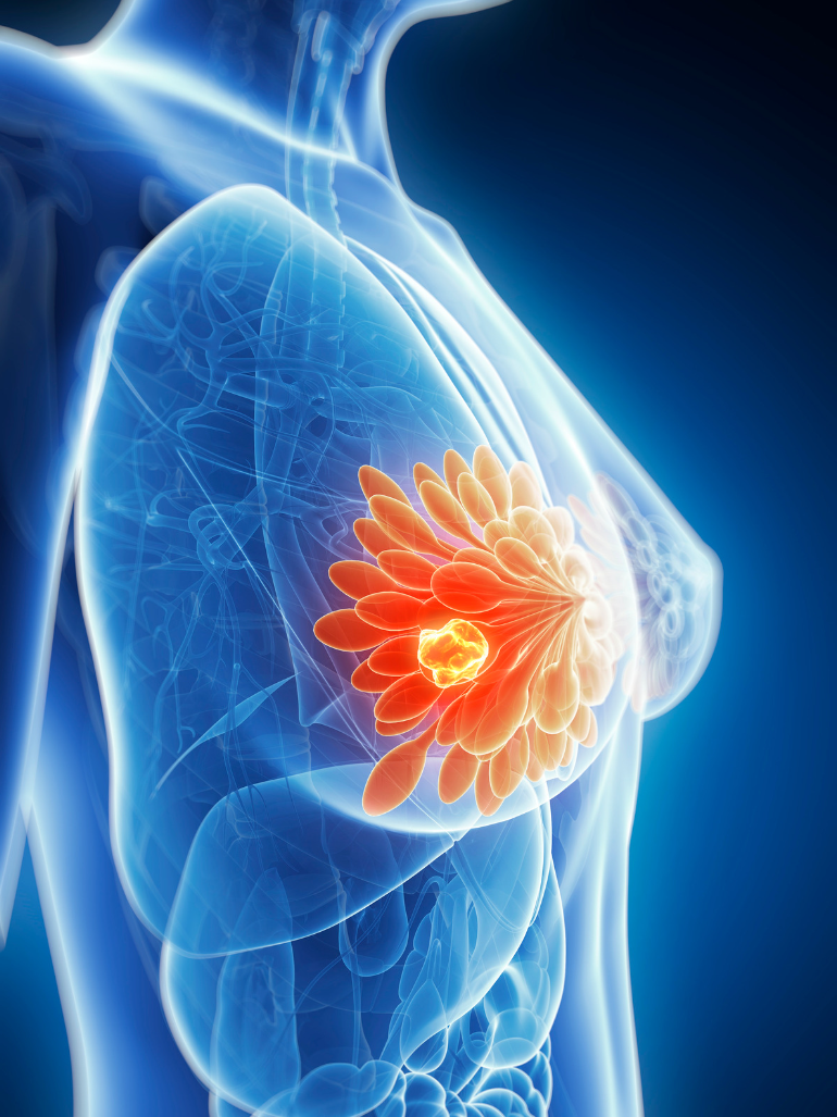 breast cancer risk factors