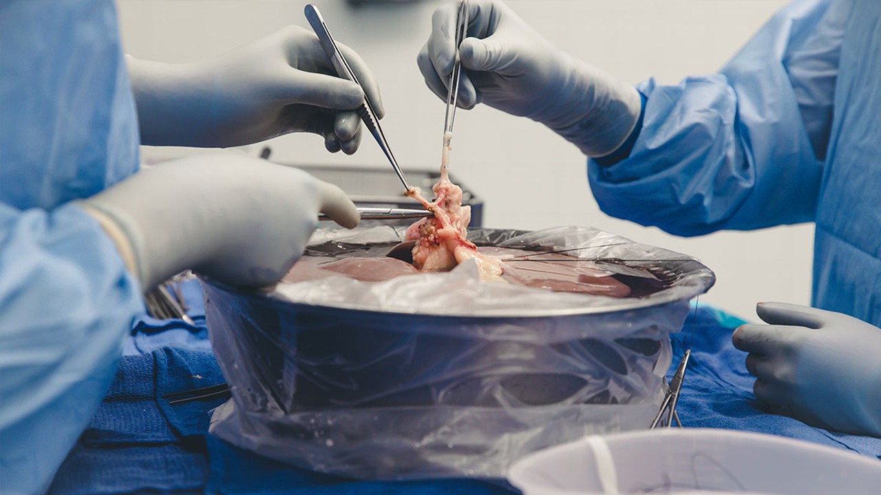 Liver Transplant Transistion