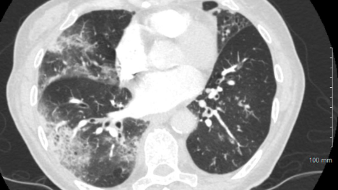 COVID-19 Lung X-Ray - 1 - Lung Damage