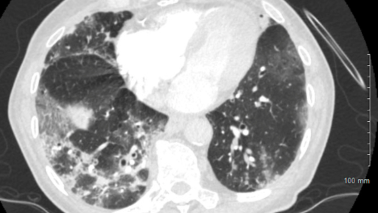 COVID-19 Lung X-Ray - 2 - Lung Damage