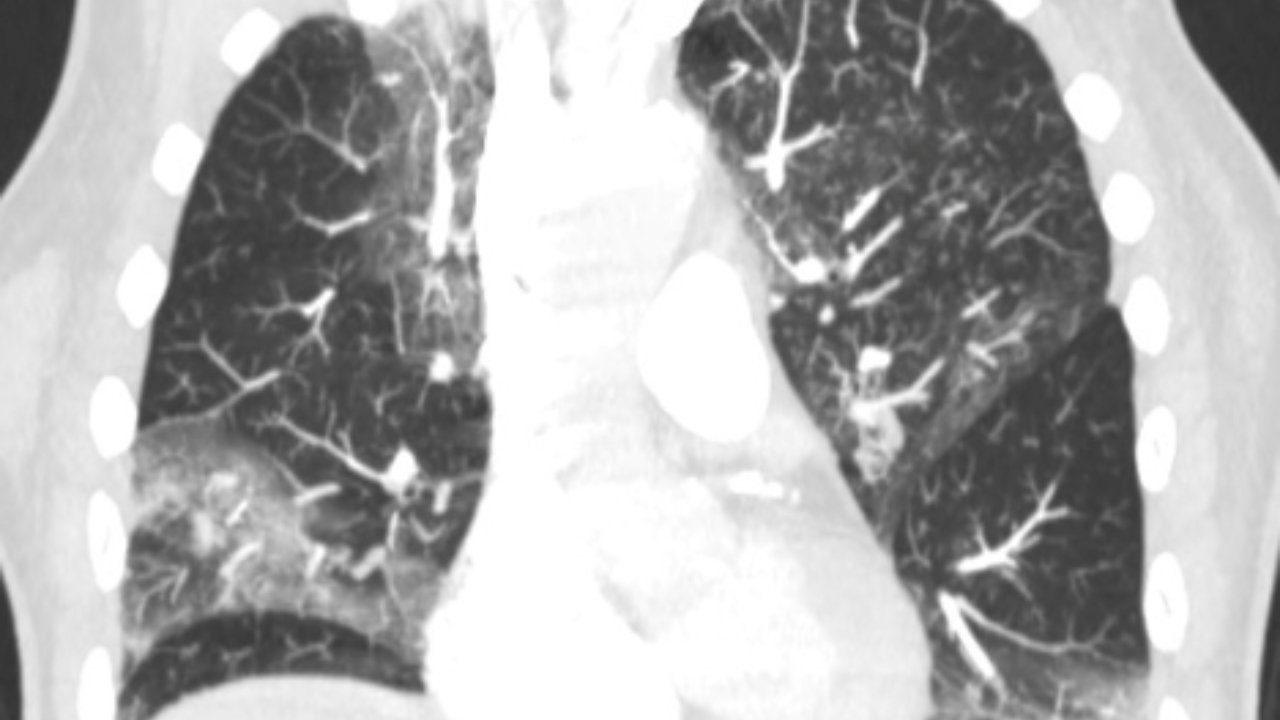 COVID-19 Lung X-Ray - 3 - Lung Damage