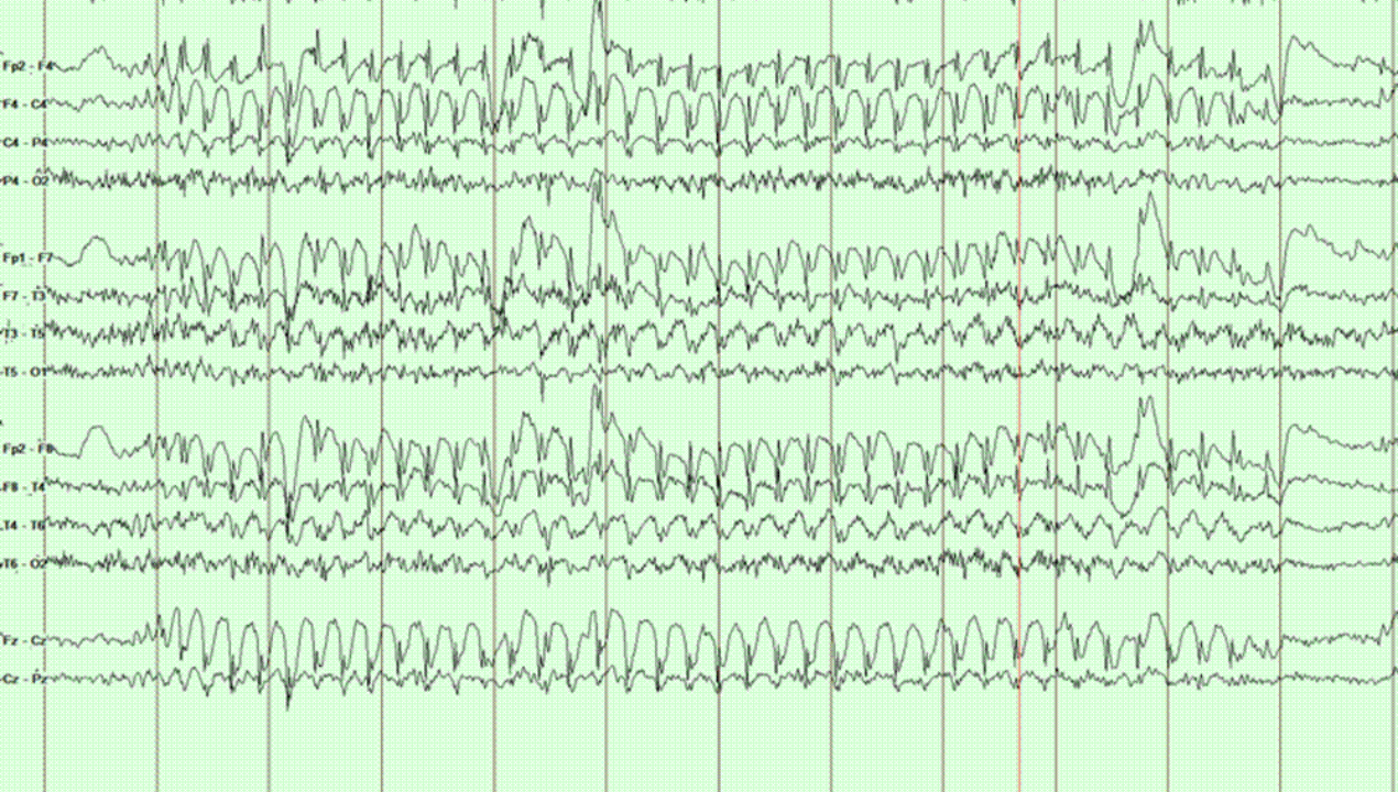 An EEG reading showing seizure activity