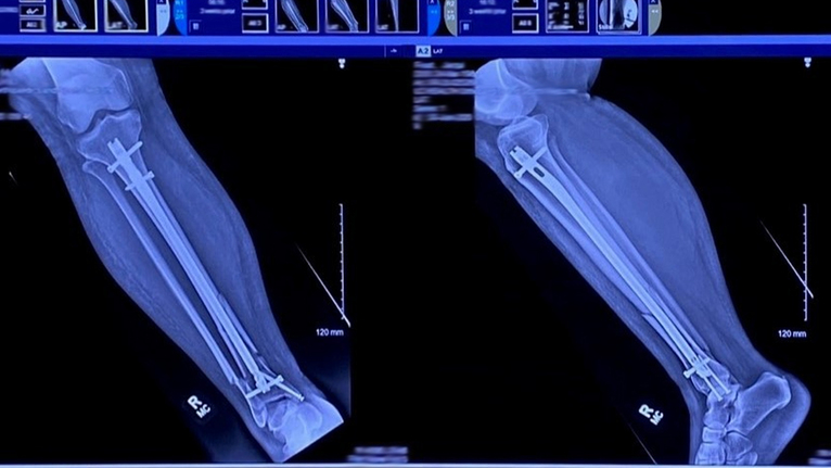Ankle Surgeon Fixes Mother's Complex Injury