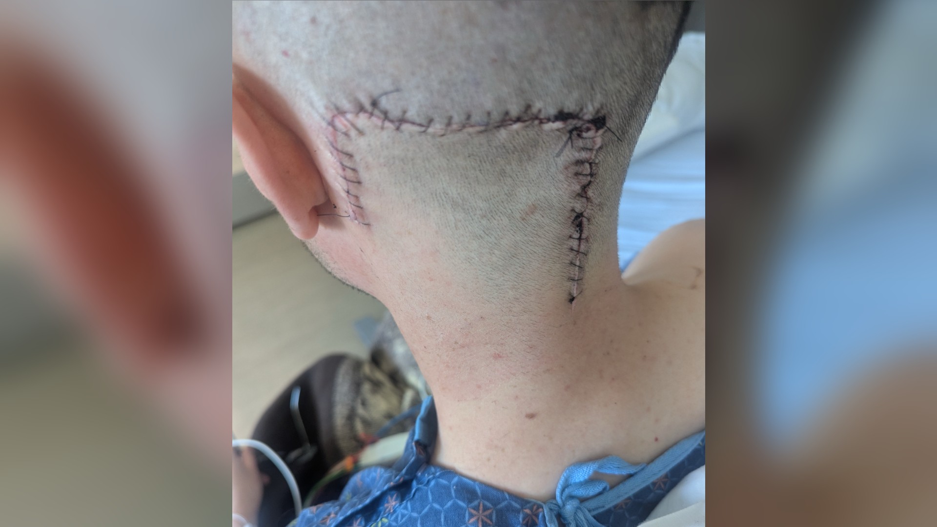 Patrick's post-surgery scar on the back of his head.