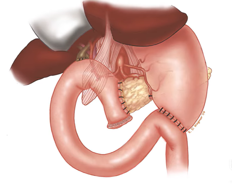 Illustration of a Whipple Procedure