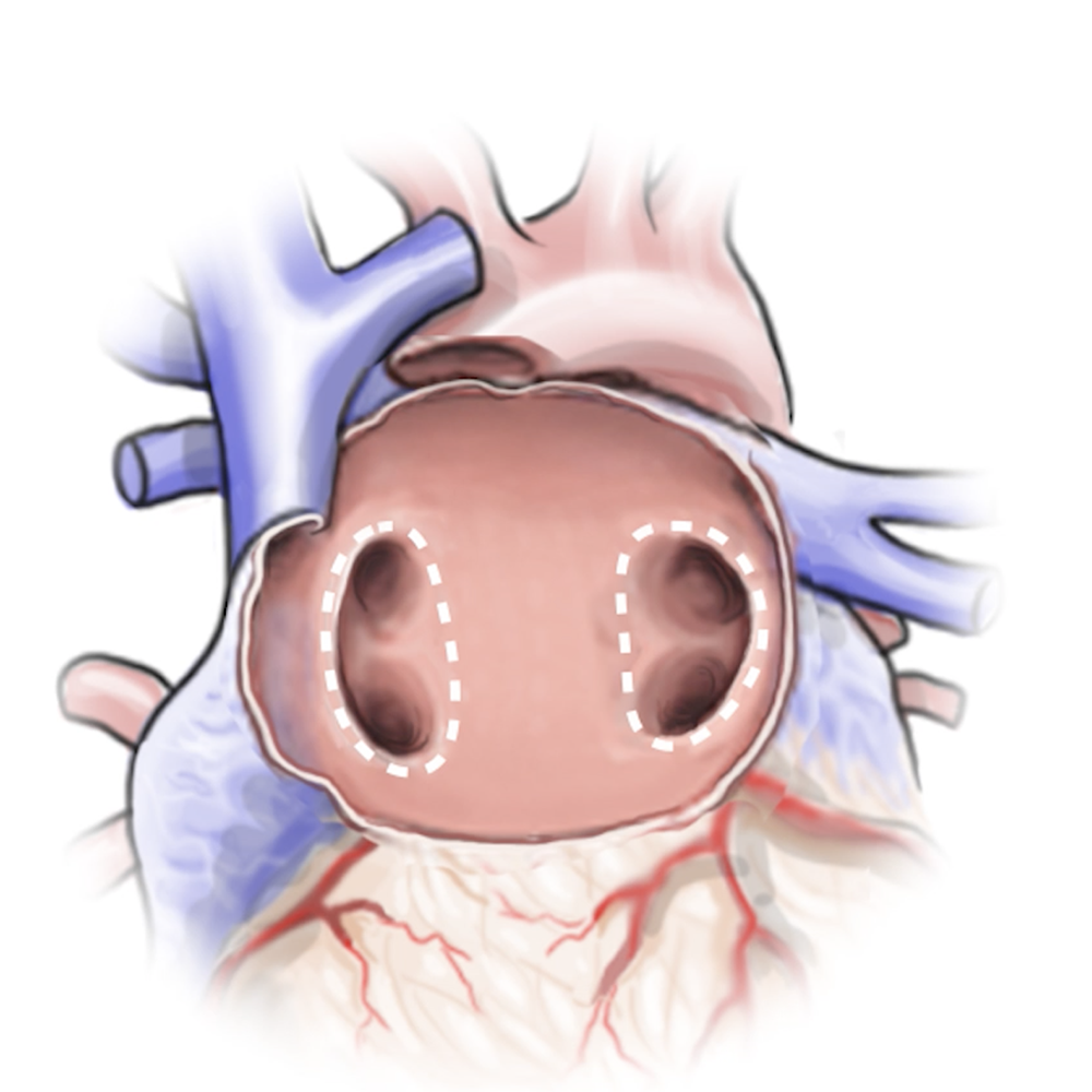 Illustration of human heart showing edocardial view (inside the heart)