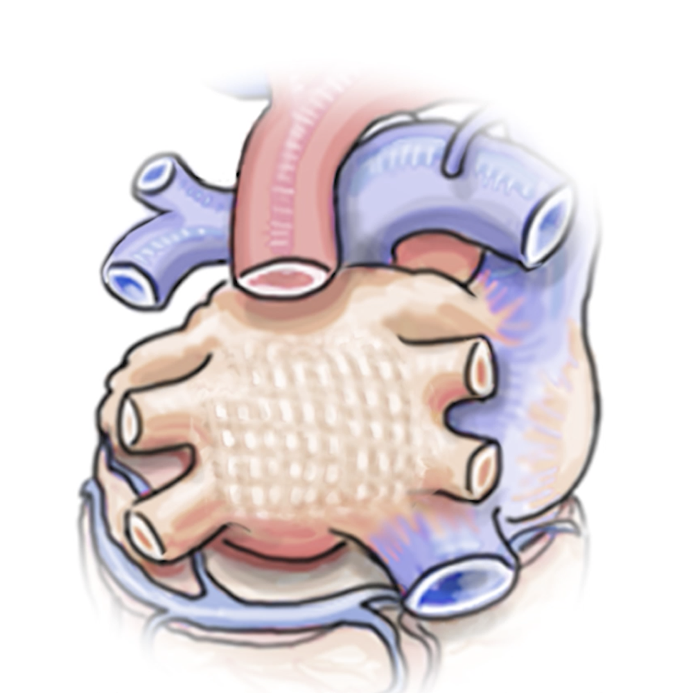 Illustration of human heart showing Epicardial: Outside the Heart