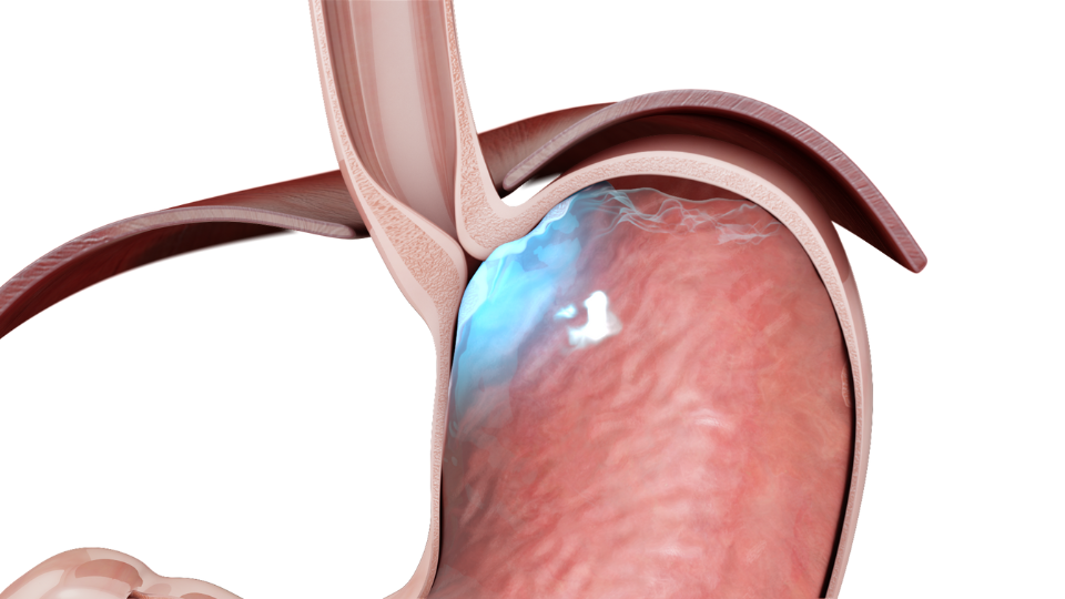 bad esophageal stomach valve connection