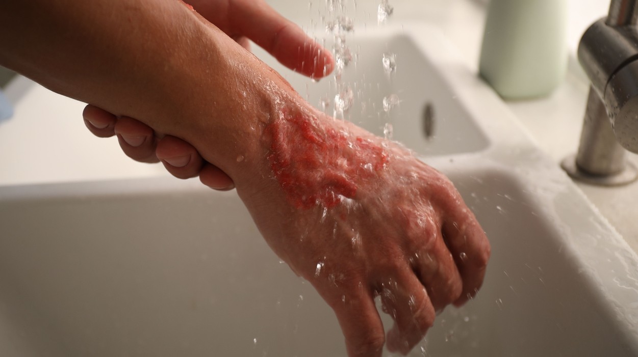 Person rinsing chemicals off a hand burn.