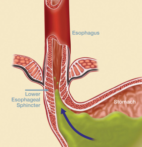 Figure 1: In people with GERD, the lower esophageal sphincter (LES) is weak, allowing acid and bile to reflux from the stomach into the esophagus.