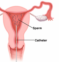 Ivf Iui