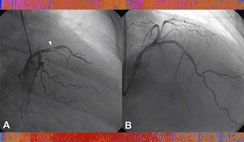 Advancing the Standard of Care: Fibrinolytic Therapy Facilitated Transradial Percutaneous Coronary Intervention Effective Treatment for Acute STEMI