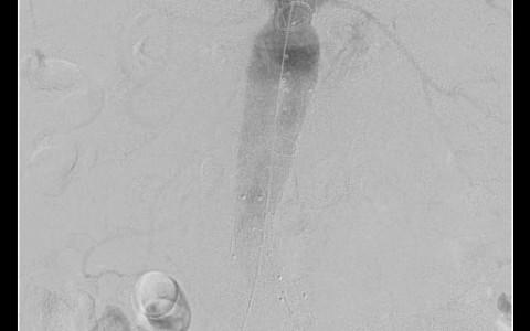 An Aortic Center with Aggressive Aortic Rupture/Trauma Protocol: The Minutes That Can Save a Life