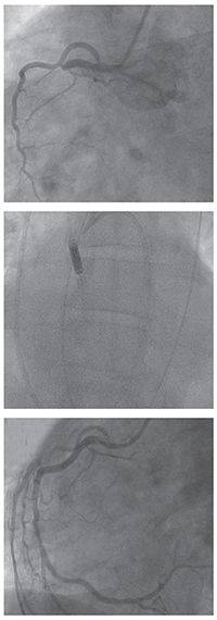 (From top to bottom): A “culprit” lesion in the proximal right coronary artery, post intervention result, and left ventricle placement of the Impella mechanical circulatory assist device to sustain cardiac output.
