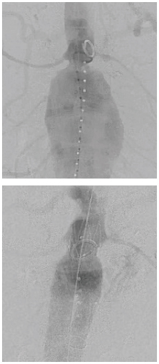 An 82-year-old male with multiple medical problems was transferred from a community hospital with a ruptured large abdominal aortic aneurysm. He was deemed inoperable at the other hospital. He arrived to the University of Cincinnati Medical Center hybrid angiographic suite and was treated with an endovascular repair of his aortic aneurysm. (Above: Pre-intervention, Below: Post-repair).