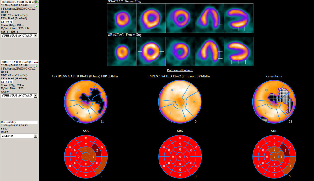 Cardiovascular Insights | Rb-82 PET/CT Facilitates Higher Diagnostic ...
