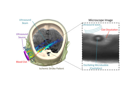 Ultrasound-Mediated Thrombolysis May Offer Promise