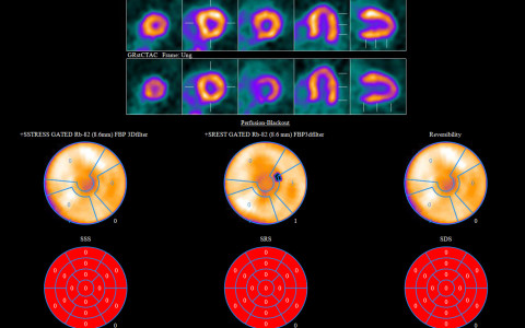 Rb-82 PET/CT Facilitates Higher Diagnostic Accuracy in CAD