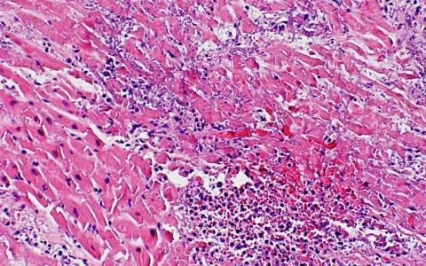 Landmark Trial to Examine Cardiovascular Treatment in HIV Patients