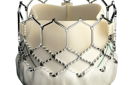 Excellent Outcomes with New Minimally Invasive Heart Surgeries