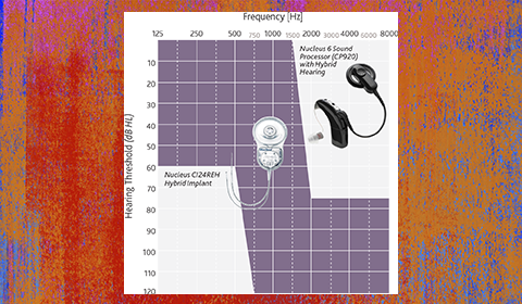 Hybrid Cochlear Implant Fills the Gap between Partial and Profound Hearing Loss