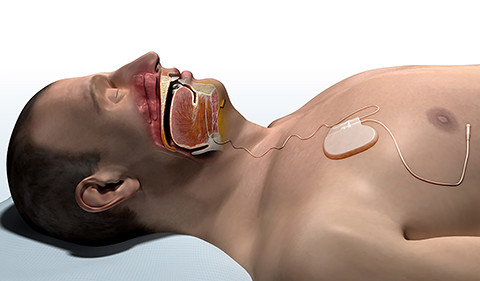 State-of-the-art Hypoglossal Nerve Stimulation Therapy Offers Option to Traditional Treatment for Obstructive Sleep Apnea
