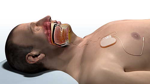 State-of-the-art Hypoglossal Nerve Stimulation Therapy Offers Option to Traditional Treatment for Obstructive Sleep Apnea