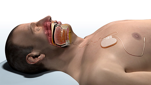 Hypoglossal Nerve Stimulation Therapy Source: Inspire Medical