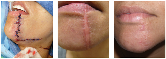 Hypertrophic scar on the lower lip and chin. A scar revision was performed followed by application of paper tape for three months. Postoperative photo of the area with no makeup 12 months later.