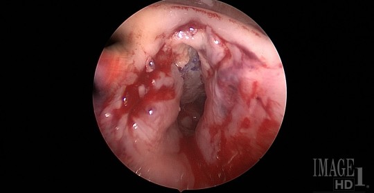 Case Study: Nationally Renowned Adult Airway Reconstruction Program