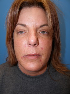 Facial Nerve Injury Before Image 1