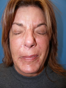 Facial nerve injury before image 2