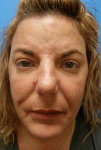 Facial nerve injury after surgery 1