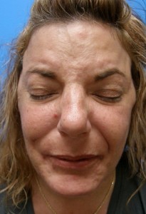 Facial nerve injury after surgery 2