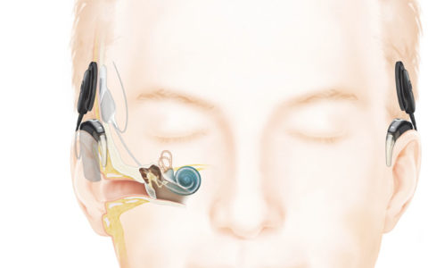 Technological Advances and Research Continue to Transform Hearing Outcomes