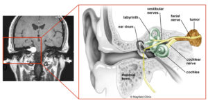 This image shows a benign tumor of the vestibulocochlear nerve (VIII cranial nerve).