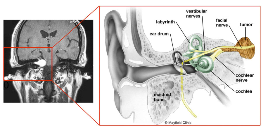 Middle Cranial Fossa Surgery Offers a Better Chance for Hearing Preservation