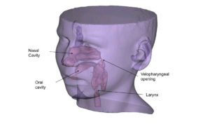 An image showing an example for the computational model used in the study. The geometry of the airway is reconstructed from CT scans of a patient with VPI. Image courtesy of Liran Oren, PhD