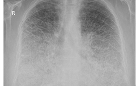 Groundbreaking Research into Rare Lung Disease Pulmonary Alveolar Microlithiasis