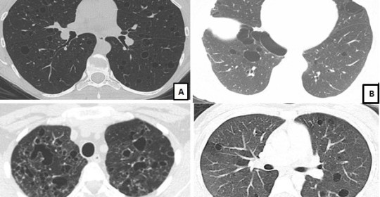 Diffuse Cystic Lung Diseases: Definitive Diagnosis is Essential for Targeted Treatments
