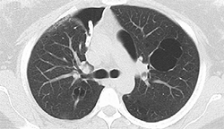 2. Pre-IBV valve placement showing CT on a right-sided pneumothorax