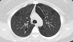 4. Pneumothorax resolved after IBV and talc pleurodesis