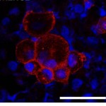 NKG2D ligand Expression on Pulmonary Cells Activate the Immune System in COPD