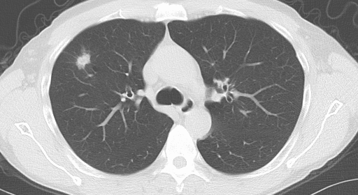 Tackling Lung Cancer: A Multidisciplinary Approach to Screening and Research