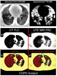 mri-in-the-lung-thumbnail